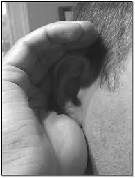 cupped ear